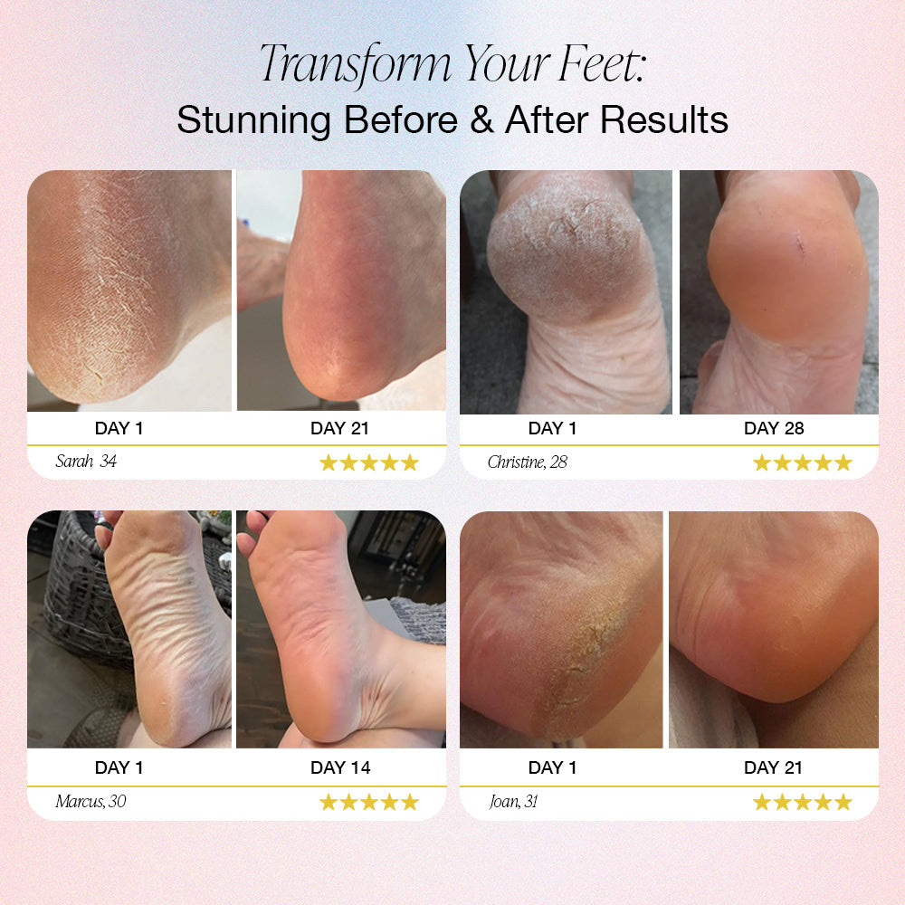 Auranex Electric Foot Callus Remover