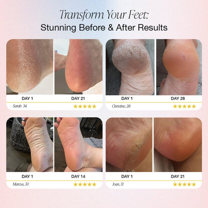 Auranex Electric Foot Callus Remover